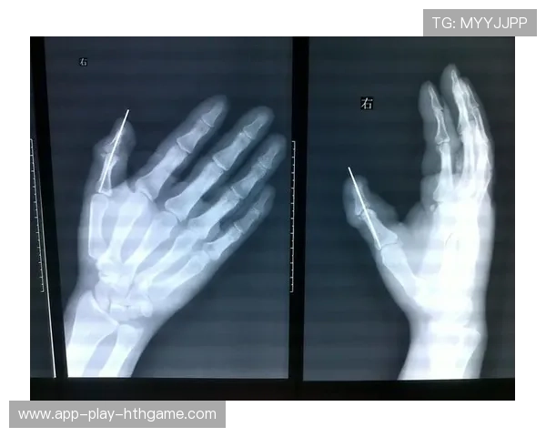 深度解析职业选手的手部伤病康复训练流程